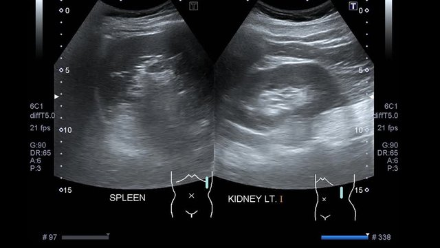 Ultrasound scan medical imaging of abdomen showed bladder.
