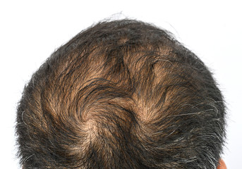 Top view of men's head with thin hair and a hair whorls. Hair whorl is a patch of hair growing in a circular direction around a visible center point.