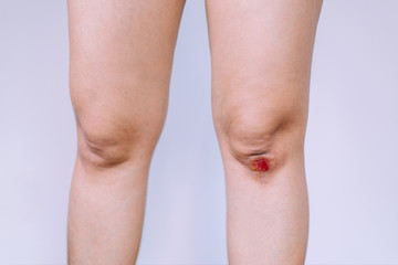 Woman suffering from bleeding wound on her knee on white blackground,Scab becomes Infected