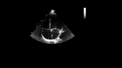 Image of the heart in gray-scale mode during transesophageal ultrasound.