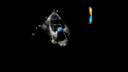Image of the heart during transesophageal ultrasound with Doppler mode.