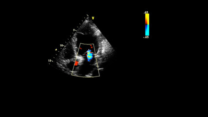 Image of the heart during transesophageal ultrasound with Doppler mode.