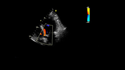 Image of the heart during transesophageal ultrasound with Doppler mode.