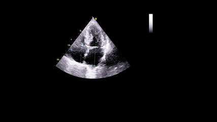 Image of the heart in gray-scale mode during transesophageal ultrasound.