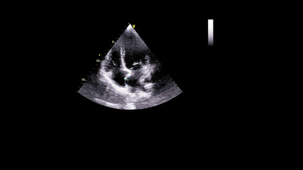 Image of the heart in gray-scale mode during transesophageal ultrasound.