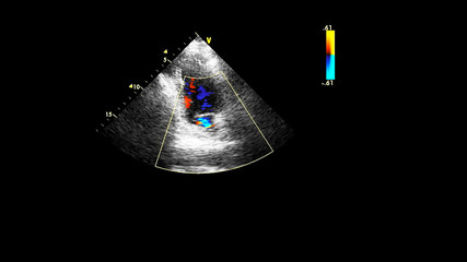 Image of the heart during transesophageal ultrasound with Doppler mode.