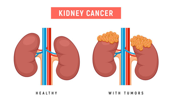 Kidney polycystic disease kidney cancer urology pyelonephritis failure tumor illustration