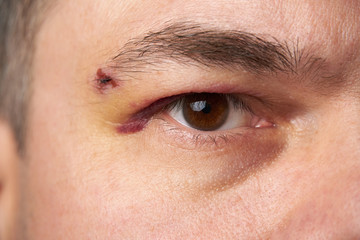 close view of a black eye, man's face with a hematoma