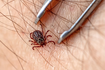 Encephalitis tick bites human body. Remove of dangerous blood sucking insect from skin. Poisonous mite bite. Removing parasite of carrier of infection in medical hospital. Bloodsucker bug stings man