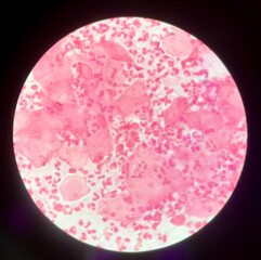 Slide show Gram negative diplococci in pus from penis .