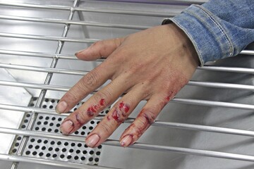 Abrasion Wound Injury Finger