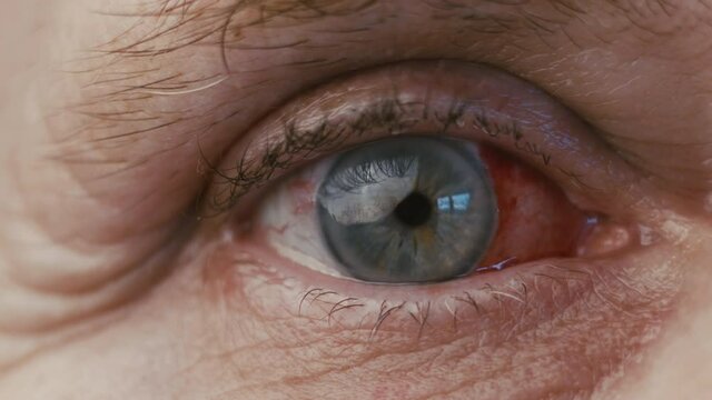 Serious eyeball infection. Eye surgery