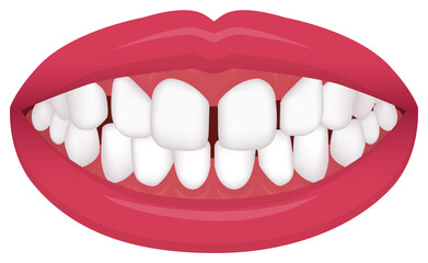 Teeth trouble ( bite type / crooked teeth ) vector illustration /Excessive Spacing