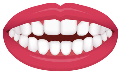 Teeth trouble ( bite type / crooked teeth ) vector illustration /Open bite