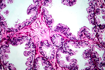 Prostate cancer, light micrograph