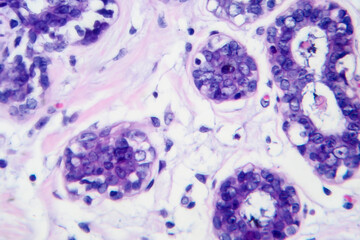 Breast cancer, light micrograph