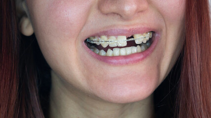 Smile of a young woman without one front tooth. Smile without upper left unit teeth. Tooth model with metal wire dental brace.