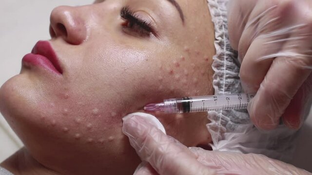 Face mesotherapy procedure in a beauty salon.
Beautician doctor makes injections into the skin of the face of a young beautiful woman.Mesotherapy, biorevitalization.Close-up. Selective focus.
