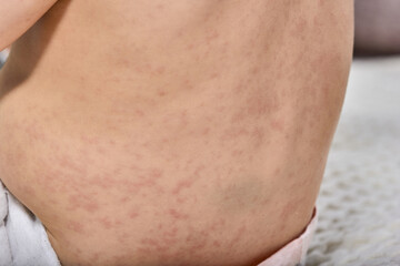 roseola rash a viral rash on the skin of a child