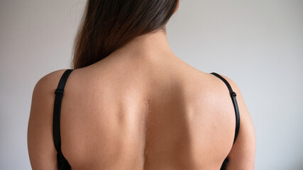 Caucasian woman's upper back with a scar.