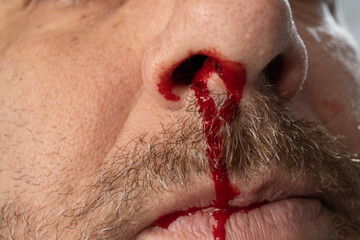 nosebleed , A man is bleeding from his nose