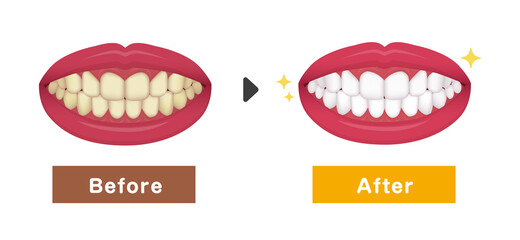 Teeth whitening vector illustration / before and after