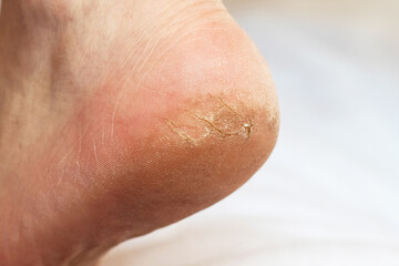 Man's leg with cracks on the heel