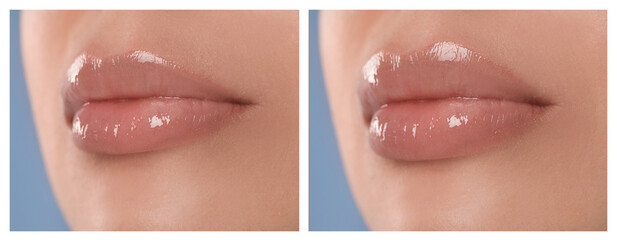 Woman before and after lip correction procedure, closeup. Banner design