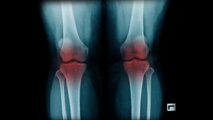 x-ray image show OA knee