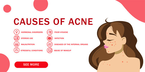 causes acne, pimple, acne, hormonal disorders, problem skin, 
Website template design for dermatologists, landing page, vector stock illustration, place text, background