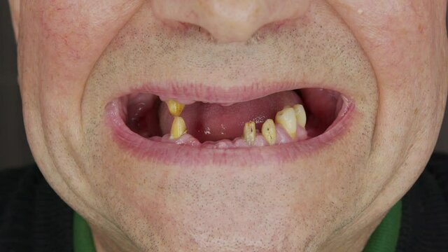 A man shows his rotten teeth.close-up toothless mouth of an elderly man.