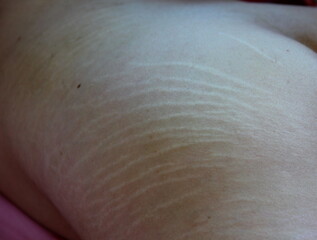 scar on woman hips or bottom with a stretch mark after more weight