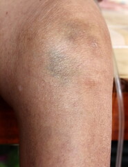 Fototapeta premium knee bone inflammation elderly woman