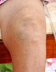 Naklejka premium knee bone inflammation elderly woman
