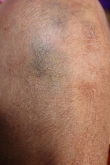 close up knee bone inflammation elderly woman