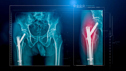 x-ray hip with internal fixation