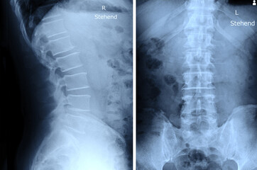 x-ray images spine