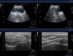 ultrasound uterus image