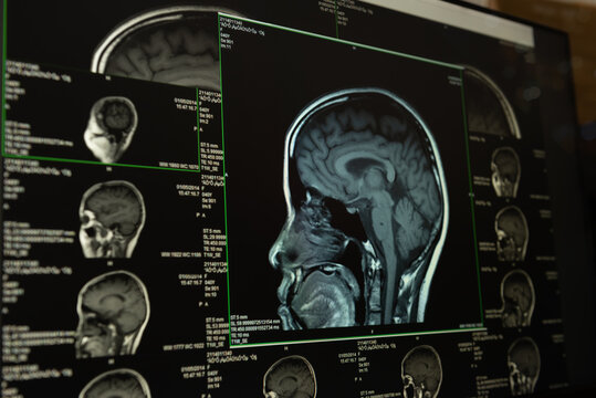 CT scan brain
