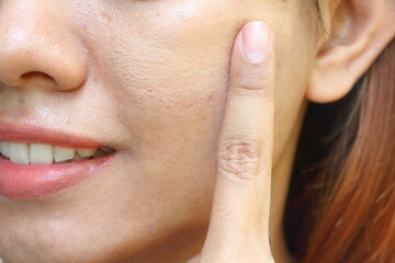 Closeup the Asian woman use fingure applying cosmetic liquid foundation on her cheek skin for hide...
