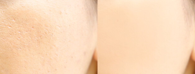Compare before and after (retouch photo) of close up wide large pores skin on oily face have pimple...