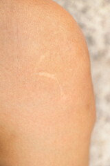 Scar on knee of Asian woman after she has accident when she was young