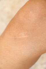 Scar on knee of Asian woman after she has accident when she was youngScar on knee of Asian woman...