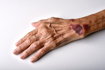 Bruise wound on senior people wrist arm skin, Falls injury accident in elderly old man.