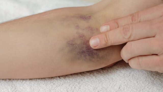 A man touches the hematoma on the elbow after an unsuccessful injection