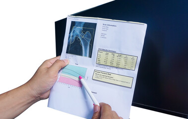 (BMD) DEXA densitometry hip scan. Osteopenia present, frequent precursor to osteoporosis on pen point on white background.Medical healthcare concept.