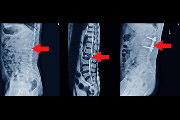 MRI of lumbar spine History of fall with back pain, radiate to leg, rule out spinal stenosis...