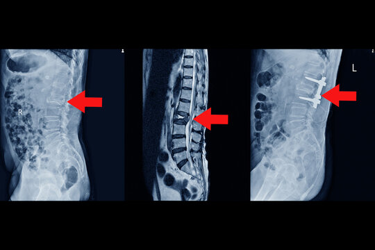 MRI of lumbar spine History of fall with back pain, radiate to leg, rule out spinal stenosis .Impression:Burst fracture of L2 vertebral body with severe vertebral collapse.on red point.Medical concept