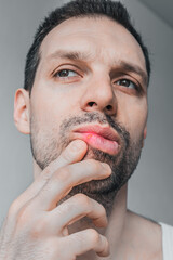 Inflammation of herpes virus on man lip. Human Infectious Disease, Fever. Sore and redness in the mouth. Coldsore treatment, health care. Unhealthy person, vertical photo. Chapped skin - obrazy, fototapety, plakaty