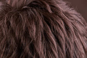 male person with dandruff disease. dermatology health care.